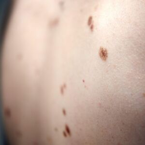 NA OVE PROMENE SE NE ŽMURI, ŽIVOT MOŽE BITI UGROŽEN! Zašto je proleće idealno vreme za kontrolu mladeža?