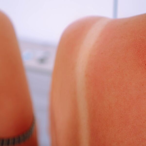 Ako krene da vas svrbi koža i dobijete osip, verovatno ste imate alergiju na sunce: Hitno uradite 1 stvar!