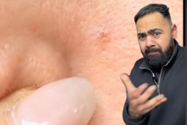 DOKTOR UPOZORIO DA OVA PROMENA NA KOŽI MOŽE UKAZATI NA RAK: Nije primetna, a evo kako izgleda (VIDEO)