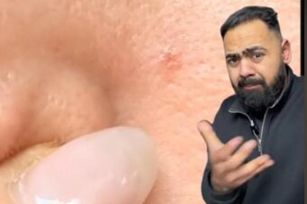 DOKTOR UPOZORIO DA OVA PROMENA NA KOŽI MOŽE UKAZATI NA RAK: Nije primetna, a evo kako izgleda (VIDEO)