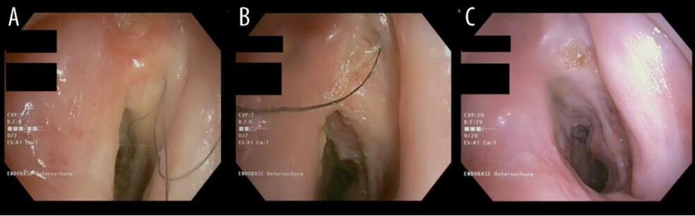 Stručnjaci otkrili da čoveku rastu dlake u grlu