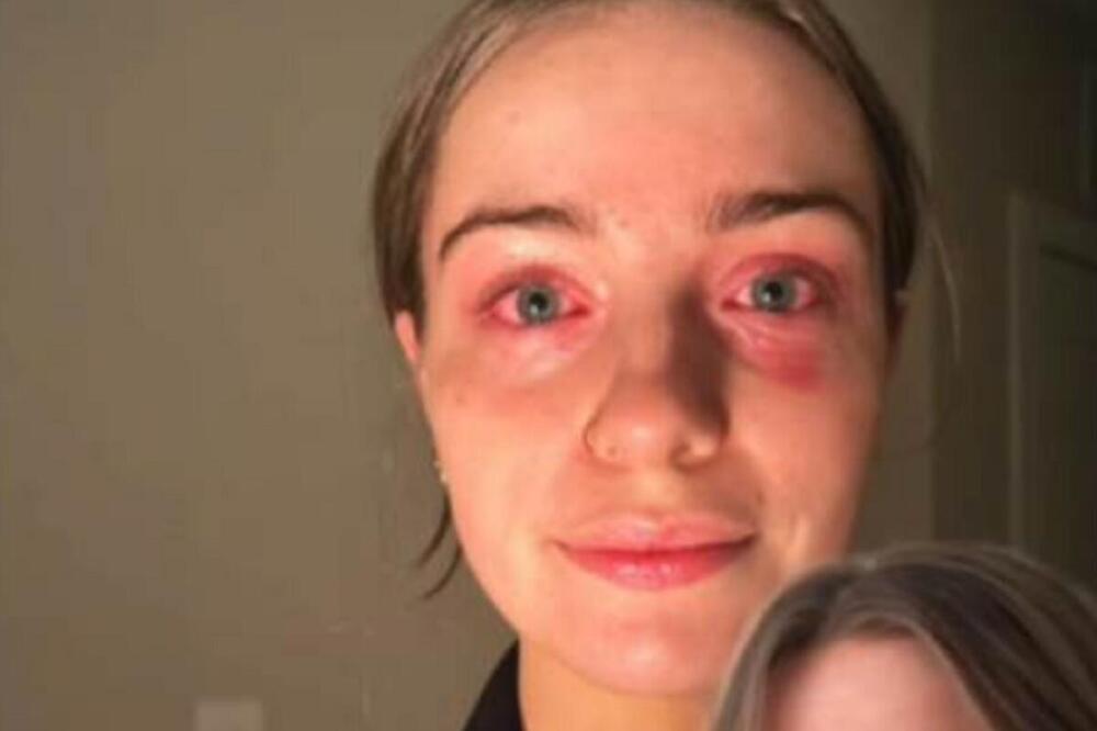 ZBOG STVARI KOJU JE PLATILA 200 DINARA PLAKALA DANIMA: Alergija je trajala POLA GODINE, probala je sve, dok nije...