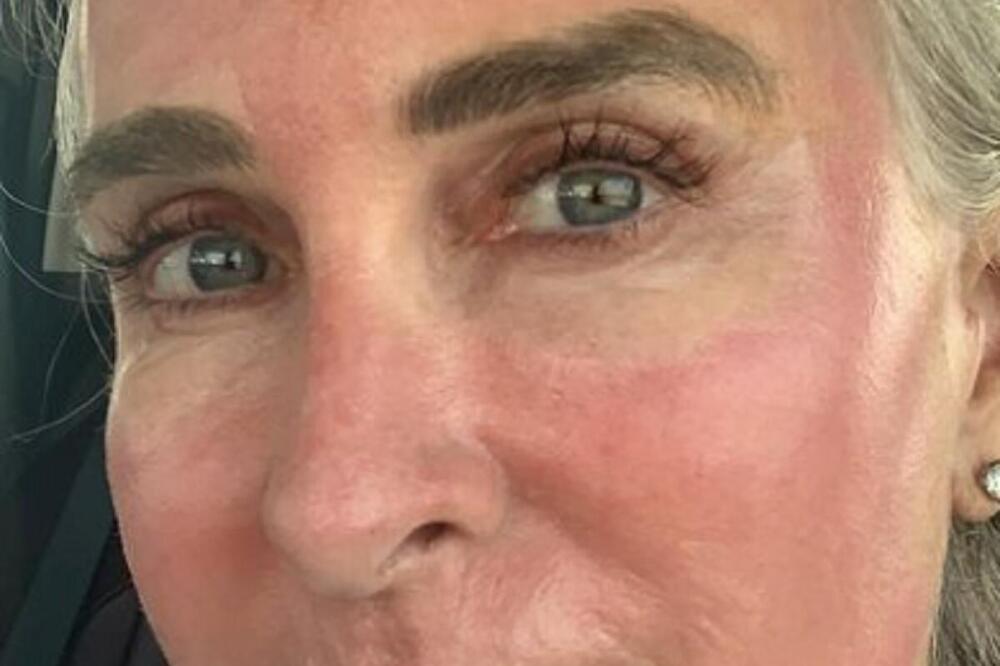 INTERNET ZVEZDA SPRŽILA LICE LASEROM: Ovo je toliko OPASNO da ćete se UPLAŠITI OD POSLEDICA, tretman koji košta