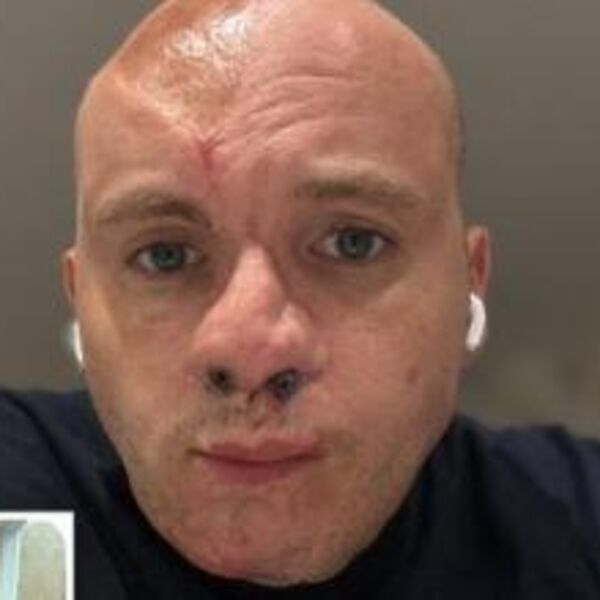 DOBIO JE NAPAD EPILEPSIJE TOKOM NOĆI, A NJEGOV PAS GA JE RASTRGAO: Uplašio se i odgrizao mu nos, jezive slike