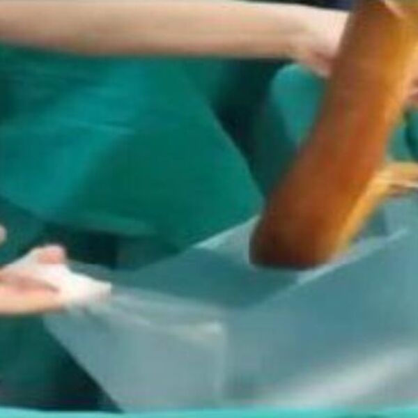 Živi monstrum dugačak čak 65 cm izvađen iz stomaka muškarca: Doktori zaprepašćeni kako je završilo tamo (VIDEO)