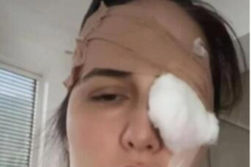 Hrvatska pevačica dobila jezivu povredu oka: Oglasila se javno, pa otkrila šta se desilo, da li je moguće?