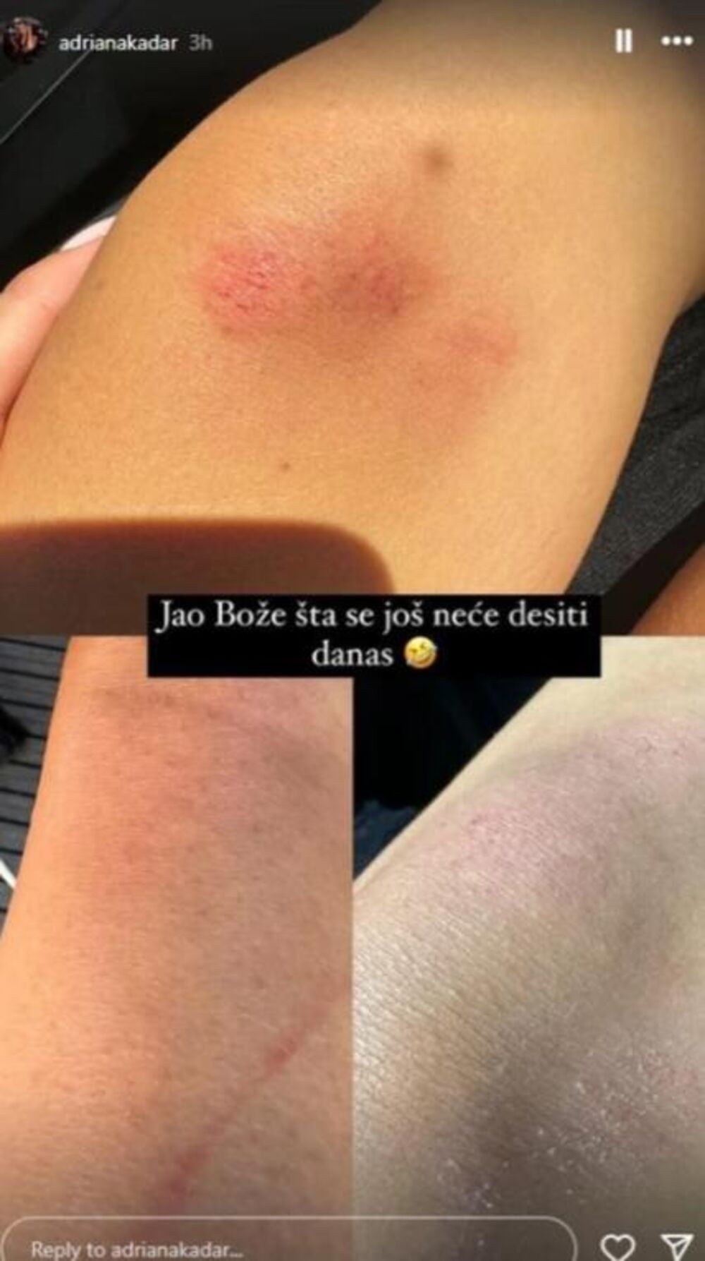 Povrede snajke Teodore Džehverović