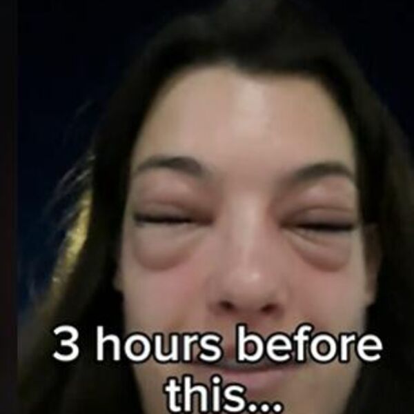 Pojela picu, pa posle 3 sata otekla kao da su je izujedali bumbari: Lekari ostali u šoku, dijagnoza bila jeziva