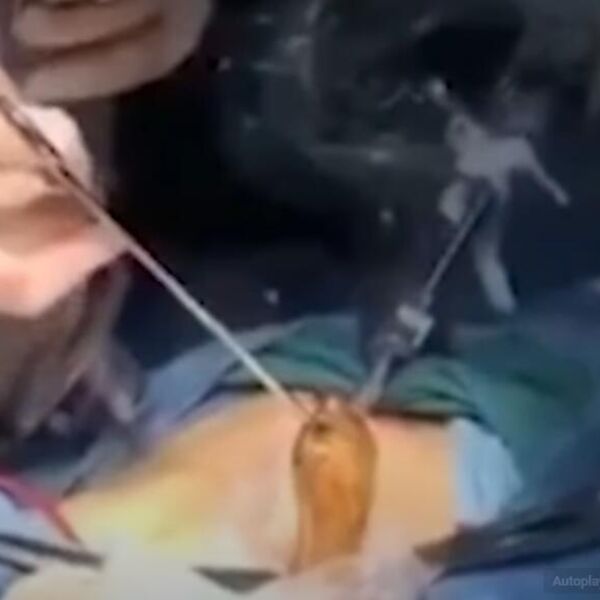 Otvorili ga na operacijskom stolu pa iz njega izvukli živo stvorenje: Lekari premrli kad su OVO ugledali pred sobom