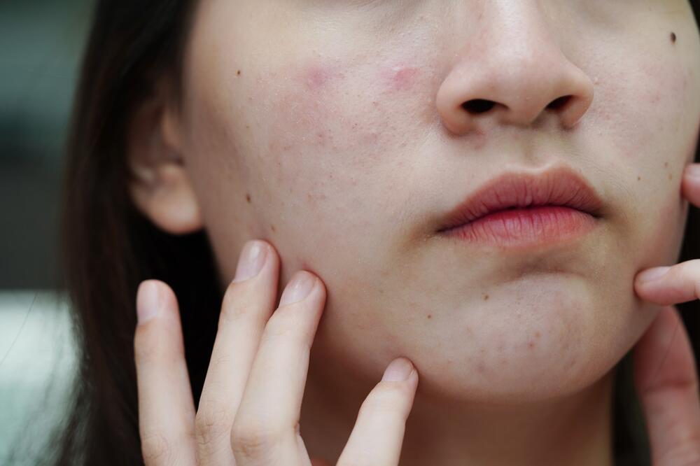 Nikako ne stavljajte pastu za zube na bubuljice! Doktorka apeluje na opasan trend, evo zašto to nije dobro