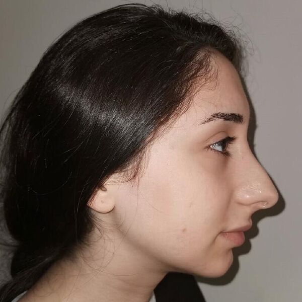 Objavljena slika devojke pre i posle operacije nosa! Ovo je druga osoba, cet svet trlja oči i ne veruje