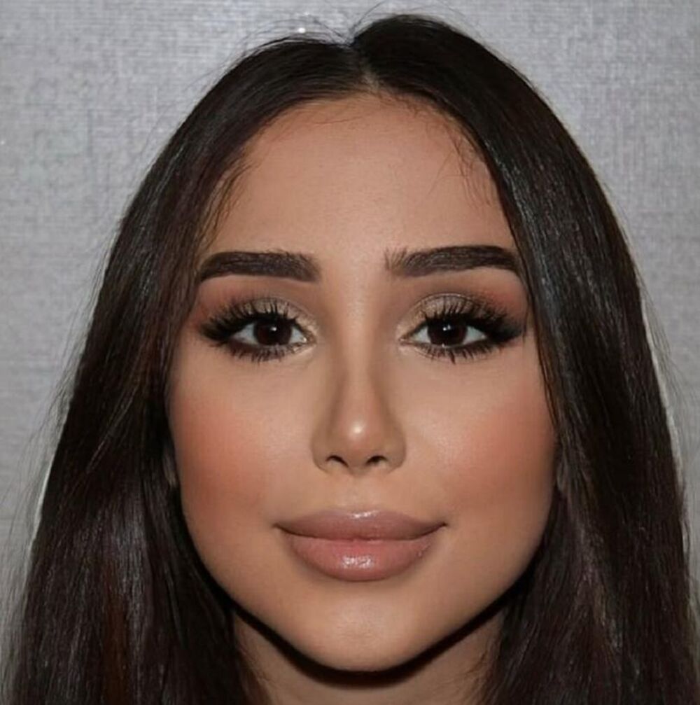 Posle operacije nosa