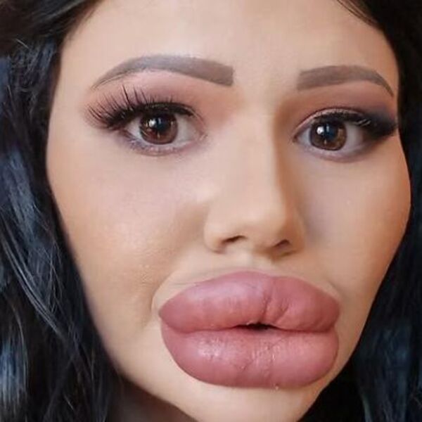 Bugarka zgadila život ljudima svojim novim usnama: Nije za one sa slabim stomakom, samo što ne puknu, šokčina