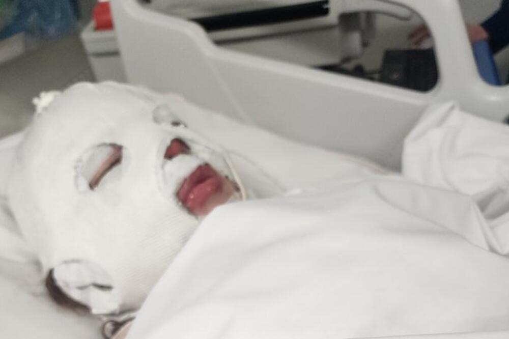 Otpalo joj 95 odsto kože nakon rekacije na lek koji Srbi masovno koriste! Jedva je izvukla živu glavu (FOTO)