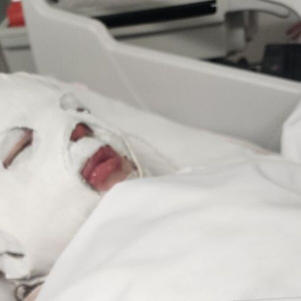 Otpalo joj 95 odsto kože nakon rekacije na lek koji Srbi masovno koriste! Jedva je izvukla živu glavu (FOTO)