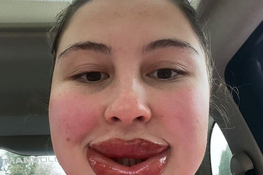 Zašto joj niko nije rekao? Uradila ovaj tretman i sad izgleda kao lik iz crtaća, nije za svačiji stomak