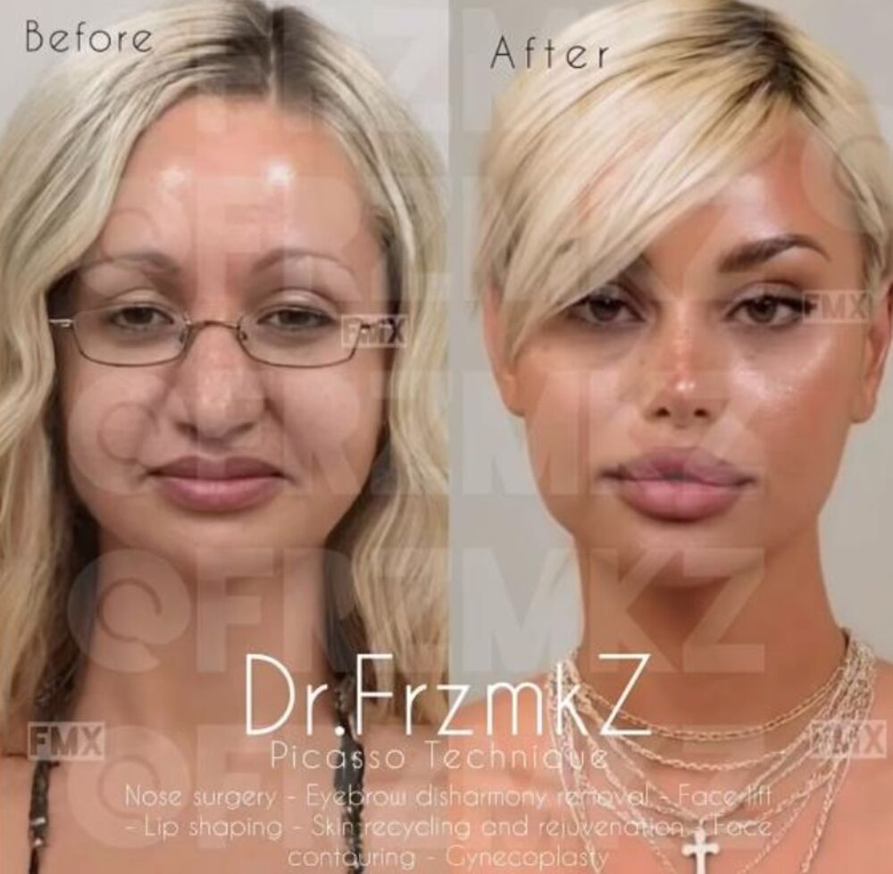 Korekcije i transformacije celog lica su hit u svetu