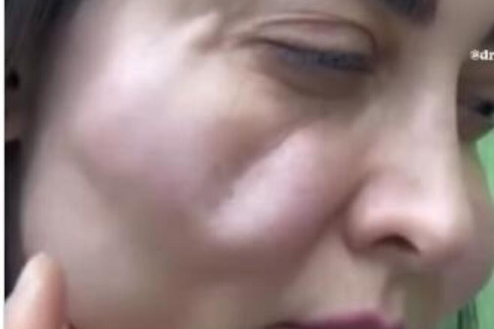 Šta se desilo licu ove žene? Obrazi se izobličili, a oči jedva drži otvorene, oglasili se doktori