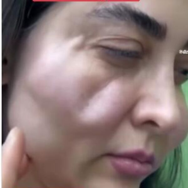 Šta se desilo licu ove žene? Obrazi se izobličili, a oči jedva drži otvorene, oglasili se doktori