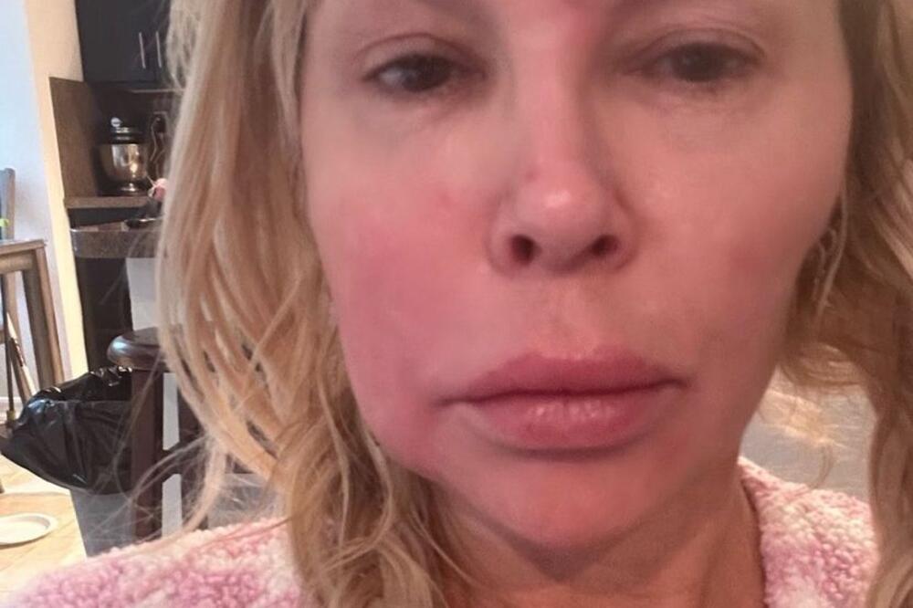 Šta joj se desilo sa facom? Rijaliti zvezda okrivila parazita za sve: "Razmnožava se i vrši nuždu u mom licu"