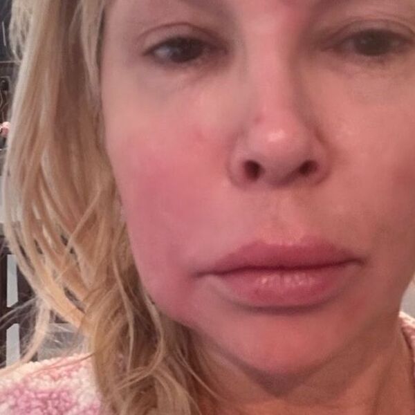 Šta joj se desilo sa facom? Rijaliti zvezda okrivila parazita za sve: "Razmnožava se i vrši nuždu u mom licu"