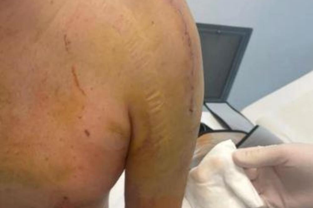 Evo kako izgleda Đanijeva ruka posle 5 lomova i operacije! Upozoravamo, prizor je uznemirujući