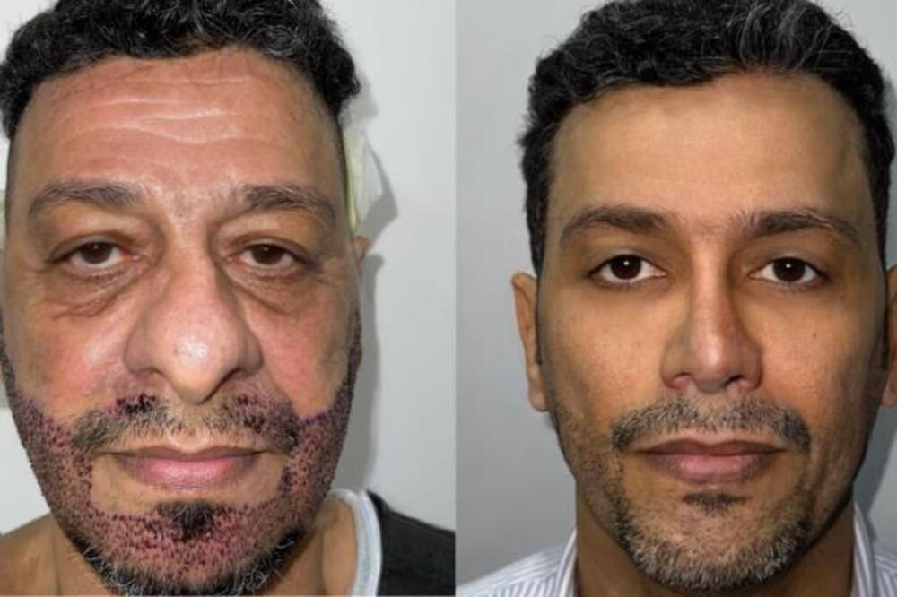 Plastični hirurg iz napravio pometnju: Pazite šta je uradio od ovog čoveka, svi se pitaju da li je ista osoba - šok