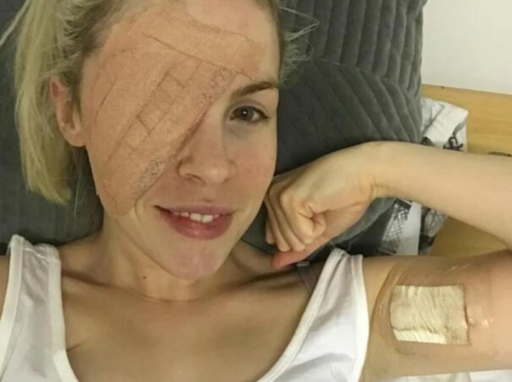 Bazocelularni karcinom na donjem kapku