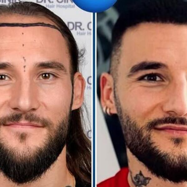 Gudelj uradio transplataciju kose i izgleda 10 godina mlađe! Evo ko je još zbog ćelavosti išao kod doktora - šok