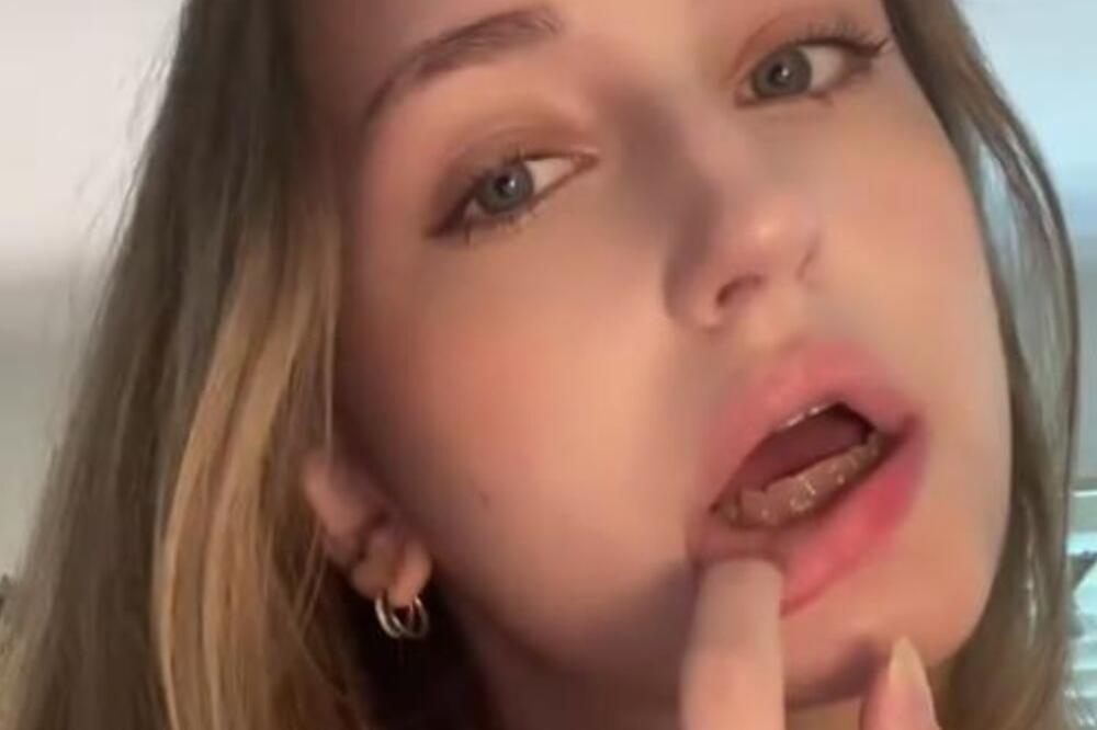 Kako je moguće da ima ovakve zube? Lako pucaju i neobične su boje - za ovo nije kriva higijena, nego...