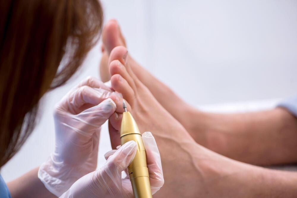 ZABORAVI NA BOL I NEPRIJATNOST URASLIH NOKTIJU: Ne morate uvek u salon, možete i sami!