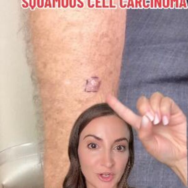 Mislite da vas je ujela buba, a ustvari imate kancer! Dr Aleksandra otkrila kako izgleda tumor na koži, šok