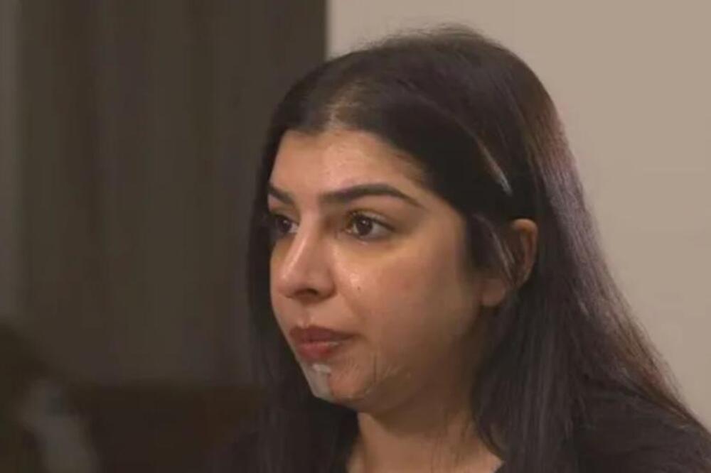 Lice joj se izobličilo nakon stavljanja ovoga u bradu: Frapiraće vas šta je sve koristila - žena je sada unakažena