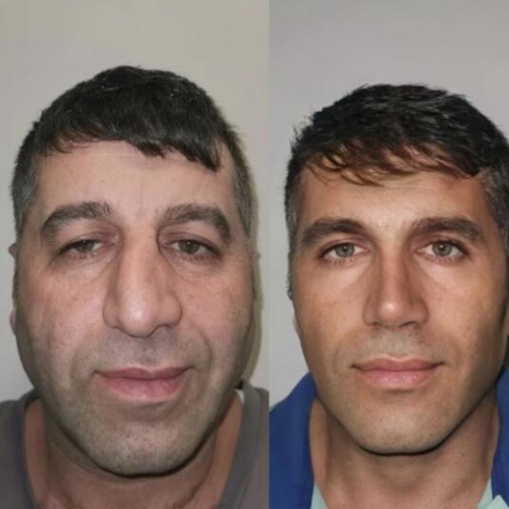 Roni pre i posle transformacije