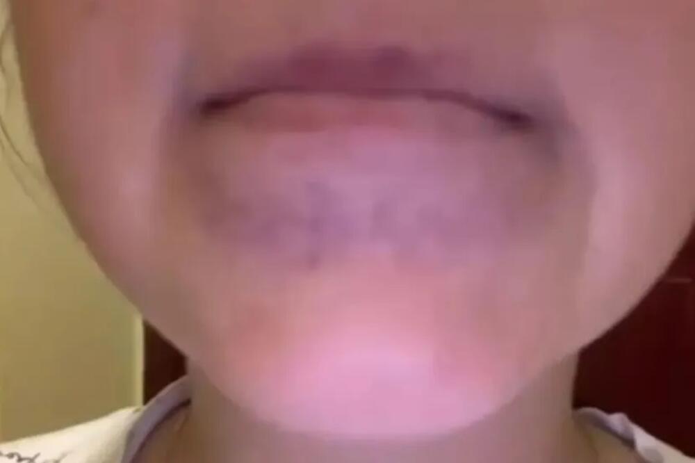 Devojčica iz Šapca završila u bolnici čim je pojela 2 kašike mlevenog paradajza: Majka ispričala horor detalje!