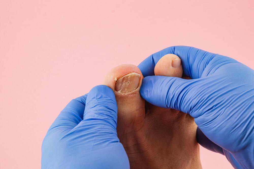 TRAŽITE REŠENJE ZA GLJIVICE? Pokažite slobodno stopala i tretirajte ih pravilno na vreme!