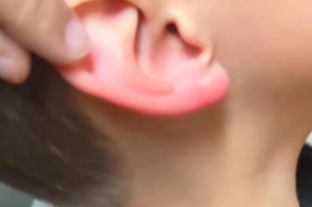 Dečak jeo roštilj, pa osetio nenormalan bol u uhu: Agonija je trajala nedeljama, na kraju je skener pokazao OVO!