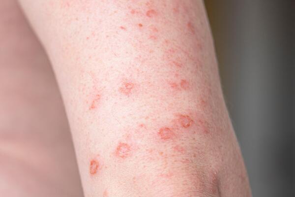 Ako vidite ovu biljku, ne dirajte je! Izaziva jake opekotine, a posebno je OPASNA ZA DECU - evo gde je ima kod nas!