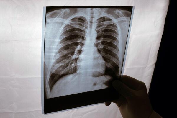 JEZIVA STATISTIKA! Od raka pluća i bronha u Srbiji godišnje oboli oko 7.000, a premine blizu 5.000 ljudi