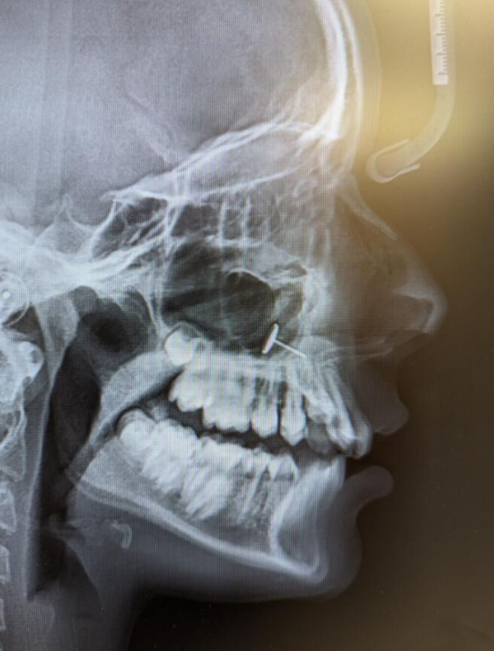 Rendgen, Rendgenski snimak