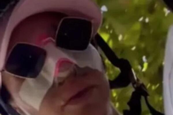 DELE SE SABLASNE SLIKE RIJALITI UČESNICE SA PINKA! Cela glava joj u podlivima, zna se i razlog