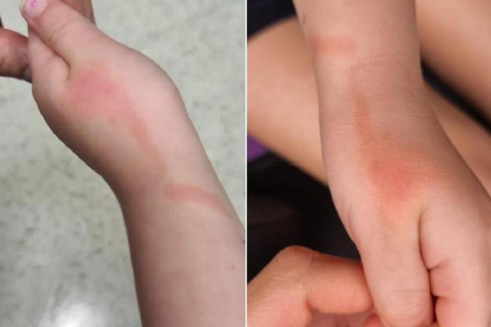 Crvena linija na koži deteta može da bude znak opasne infekcije: Ako ovo vidite, odmah idite kod lekara! (FOTO)