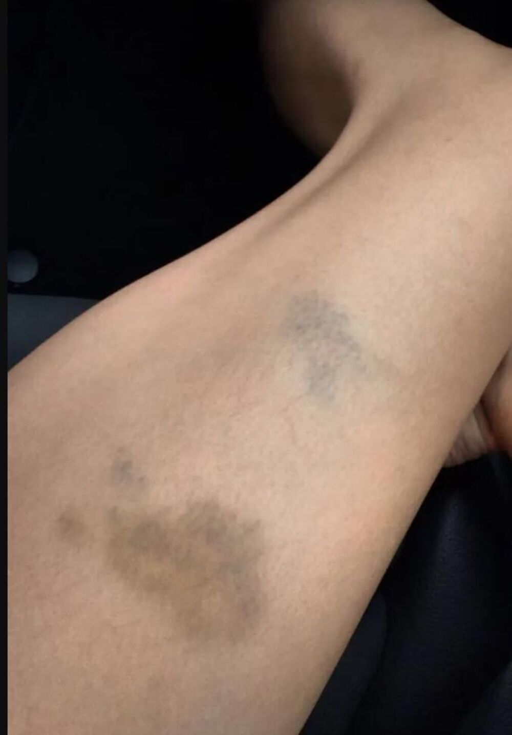 Anica pokazala modrice