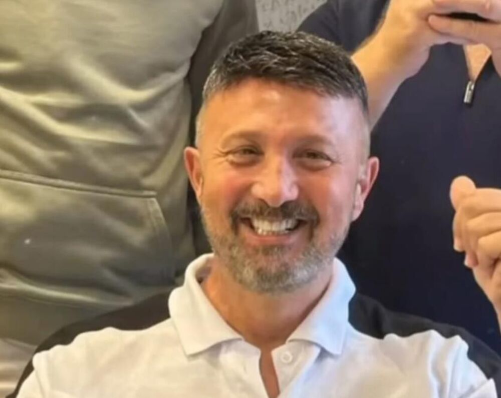 Goran posle trnasplantacije kose