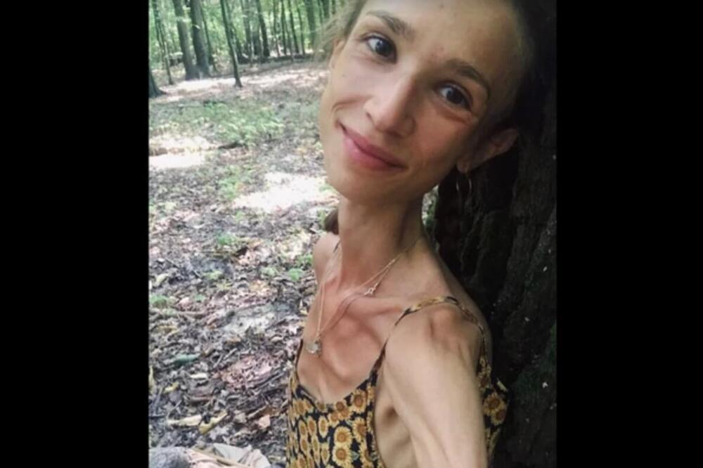 SLIKE NISU ZA ONE SA SLABIM STOMAKOM! PRVO SE ODREKLA HRANE, PA ŽIVOTA - zbog voća imala 24kg, hodala kao ŽIVI LEŠ