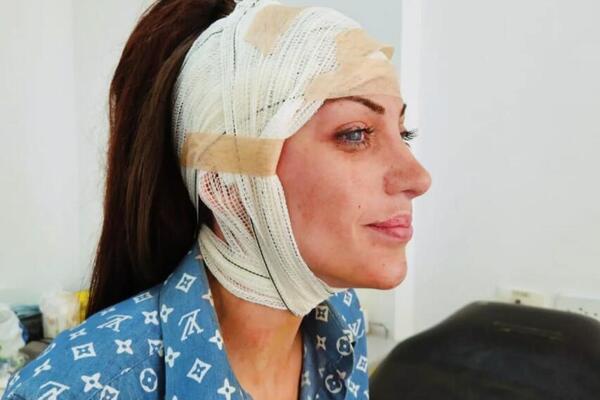 HOROR! PREMINULA ŽIVA BARBI! Kad čujete koliko je imala PLASTIČNIH operacija, neće vam biti svejedno