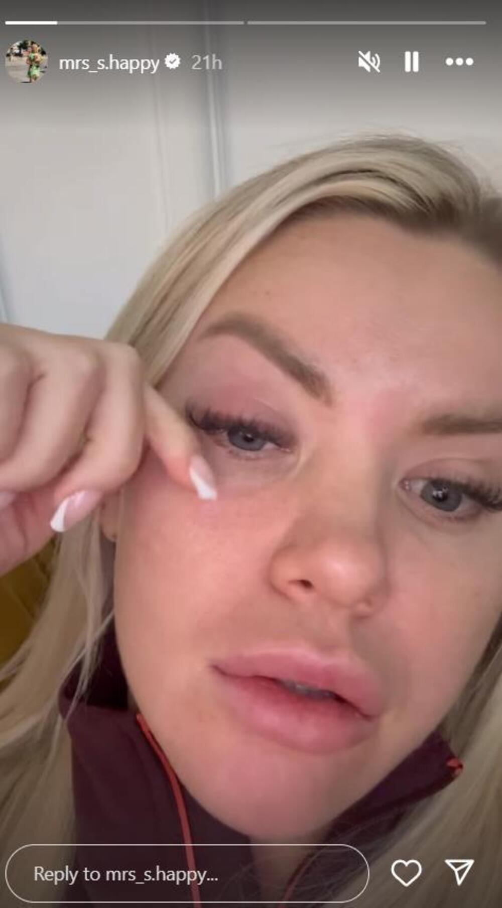 Stavila jaje na oko pa ZAKUKALA! Voditeljka Pinka trpi velike bolove - prizor nije za one sa slabim STOMAKOM