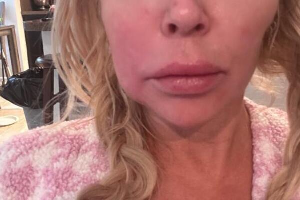 RIJALITI ZVEZDI PARAZITI "POJELI" CELO LICE! Promenili joj lični opis, slike uznemirile celu javnost