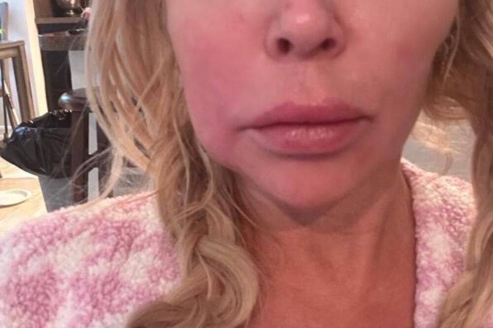 RIJALITI ZVEZDI PARAZITI "POJELI" CELO LICE! Promenili joj lični opis, slike uznemirile celu javnost