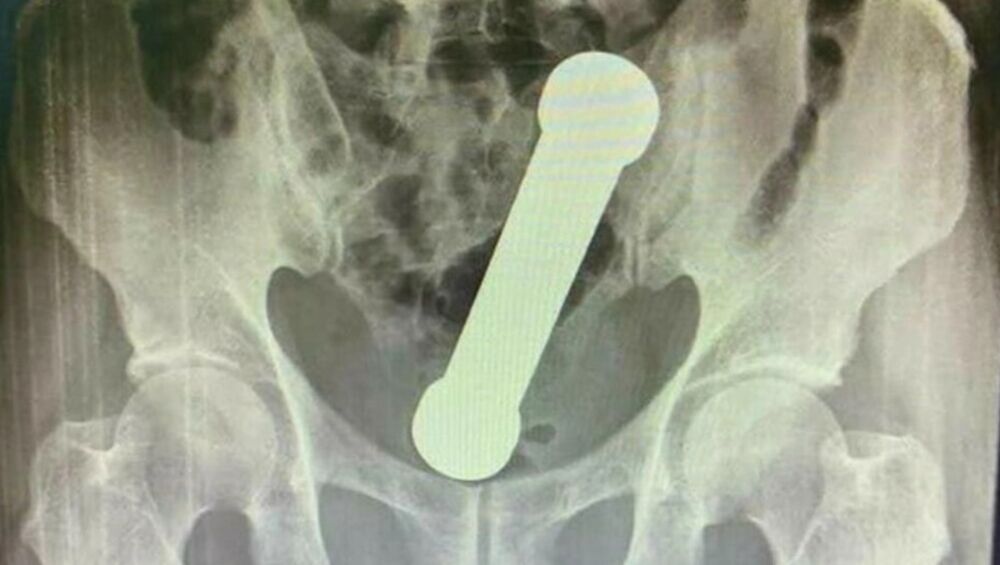 Teg u rektumu, Rektum